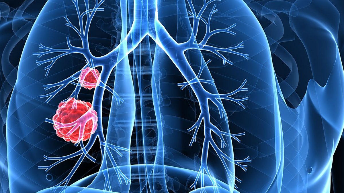Medizinische Illustration des Brustkorbes mit in rot dargestellten (Krebs-)Zellen.